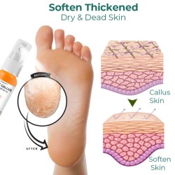 Foot Callus Removal Spray GFOUK