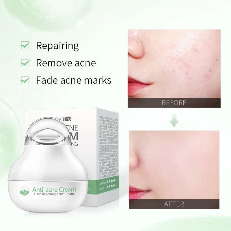 Anti-Acne Cream  Repair