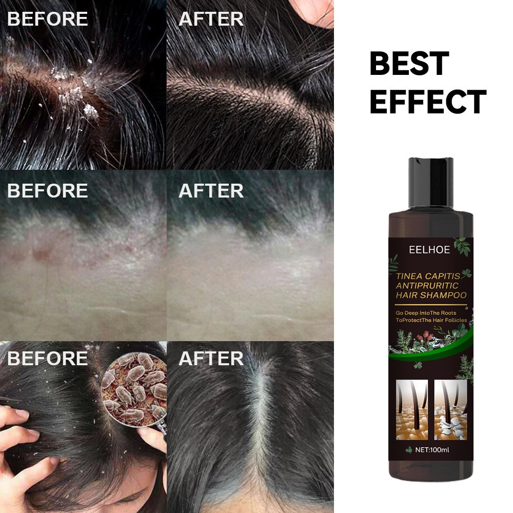 EELHOE Plant Formula Antipruritic Hair Shampoo  Dandruff Control & Hair Follicle Protection