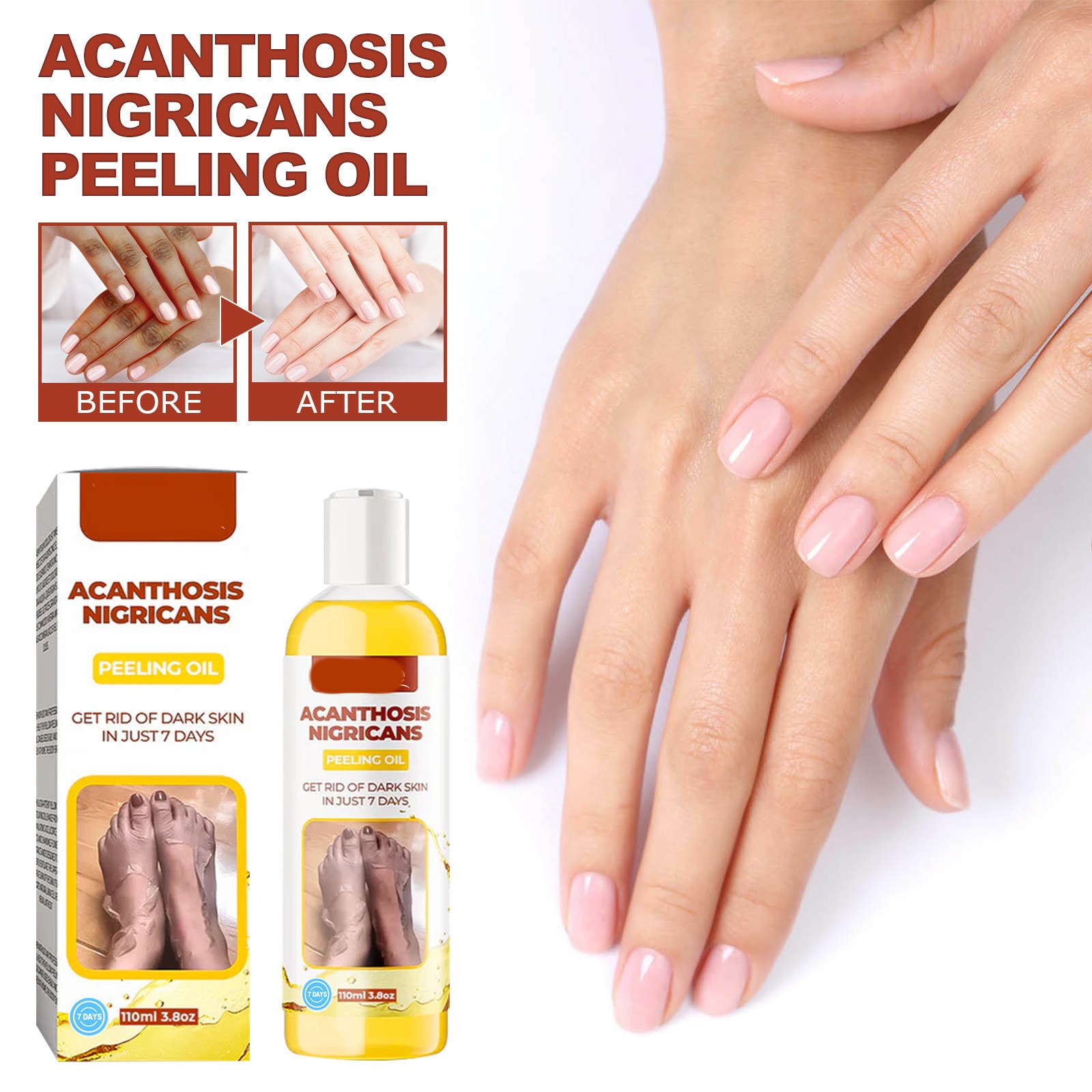 Acanthosis Nigricans Peeling Oil Remove Dark Skin in Just 7 Days