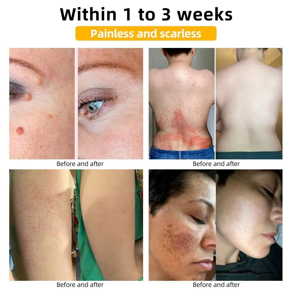 Mole And Wart Cream Fade Skin Cleaning And Repair