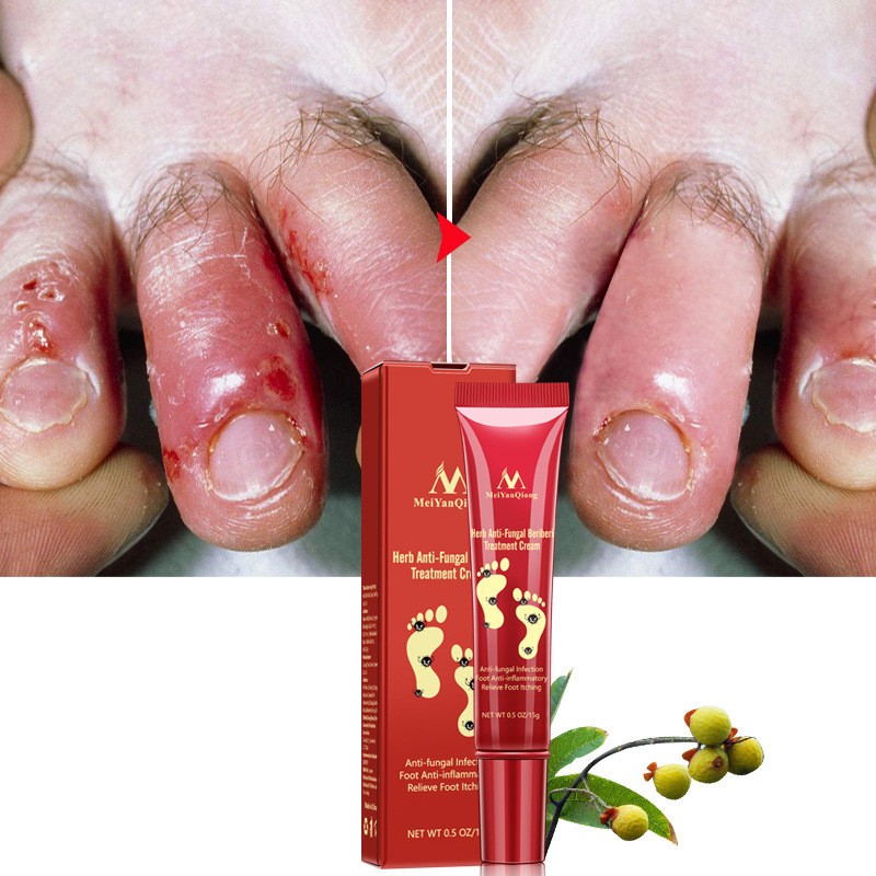 Herb Anti-Fungal Beriberi Treatment Cream