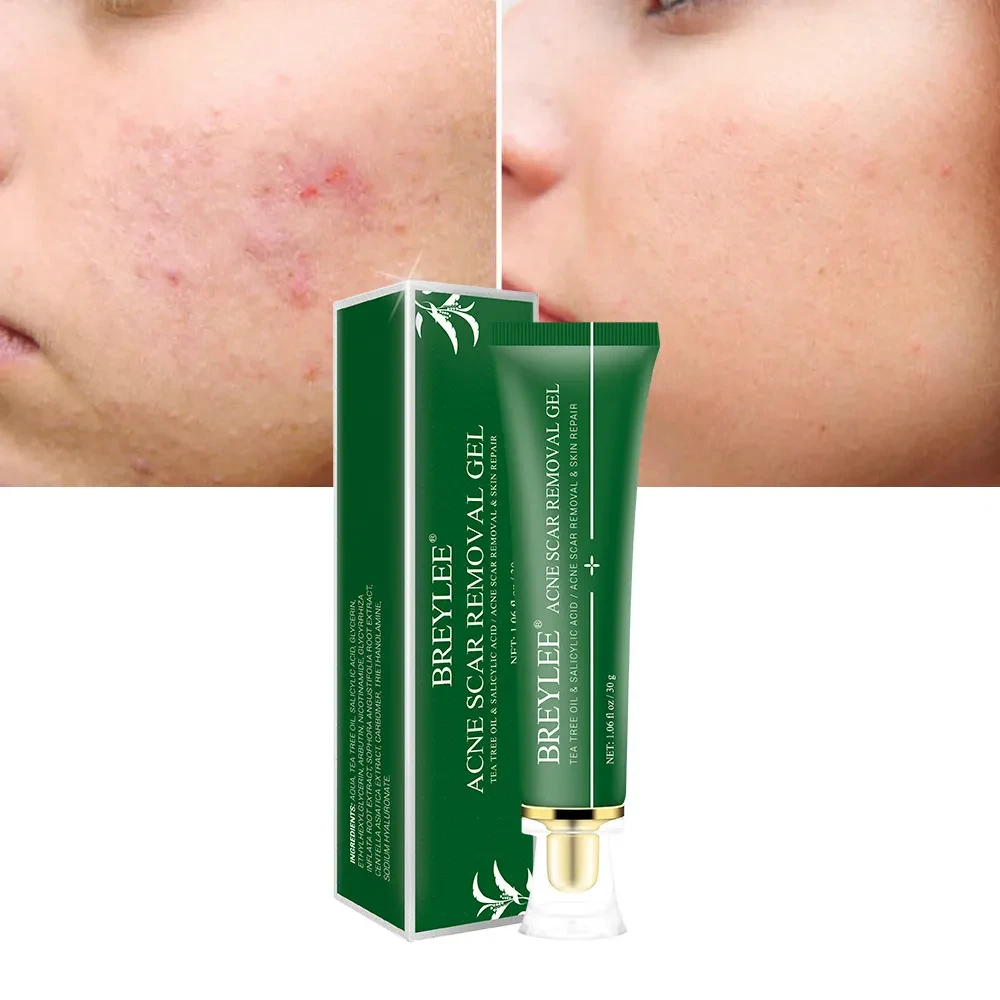 Acne Scar Removal Gel