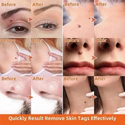 Moisturizing Facial Wart Remover Liquid