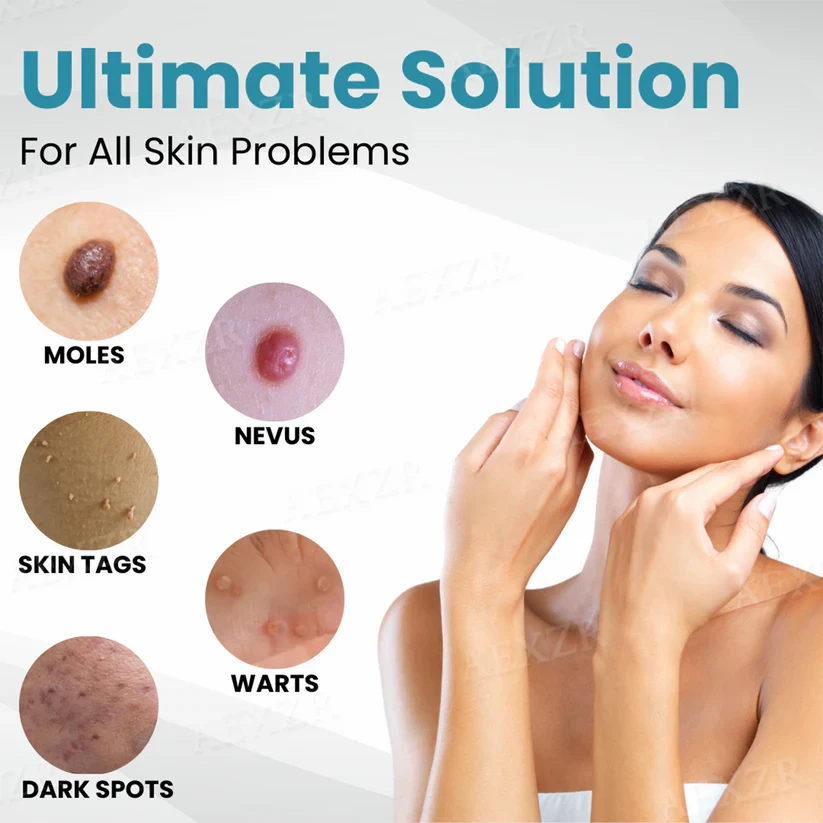 Bikenda Non-Invasive Mole and Wart Removal Laser Pen