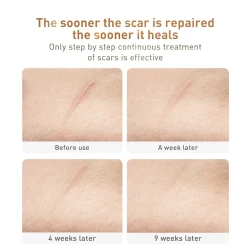 Traditional Chinese Medicine Scar Removal Cream