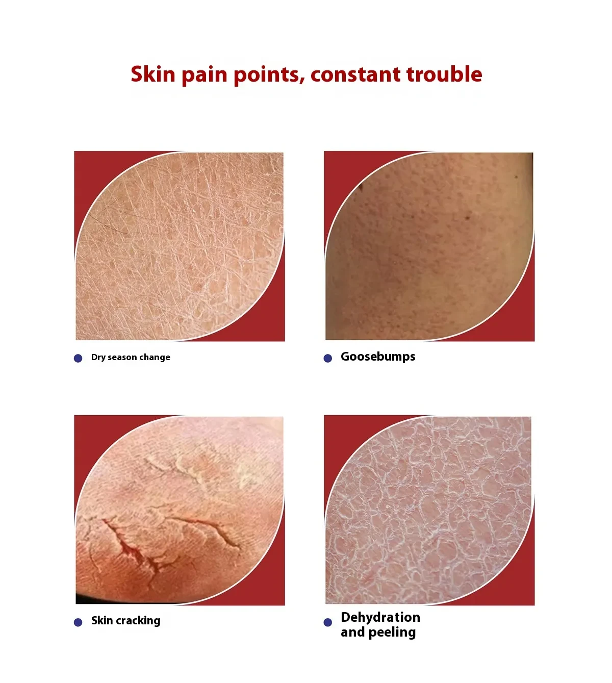 422 Salicylate Urea Cream Anti-chapping Moisturizing Cream